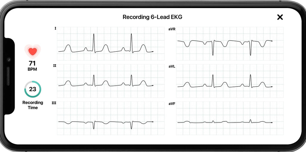 AliveCor KardiaMobile 6L Personal EKG Monitor, Black - KM-6L-E